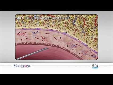 The Wand® STA Instrument - Pre Puncture and Anesthetic Pathway Techniques for Palatal Injections