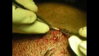 preview picture of video 'Hair Transplant Fue Hair Restoration in Switzerland 75% OFF Abroad'