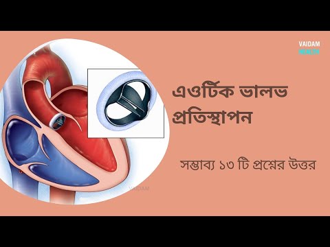 এওর্টিক ভালভ প্রতিস্থাপন- ১৩ টি প্রায়শই জিজ্ঞাসিত প্রশ্ন