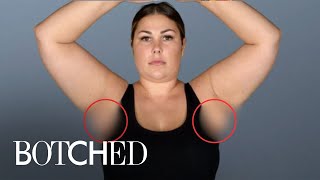 Samantha's Extra Armpit Breasts FULL TRANSFORMATION | Botched E!