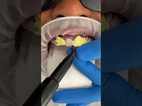 Gap closure using composite veneers ✨🤍
