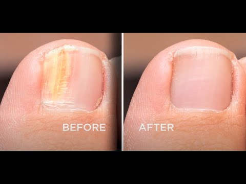 glutathione and toenail fungus The Link Between Deficiency Vitamin B12 for Injection