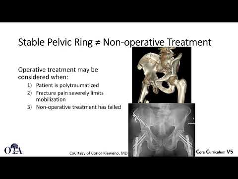 Definitive treatment of pelvic ring injuries - 1 of 3