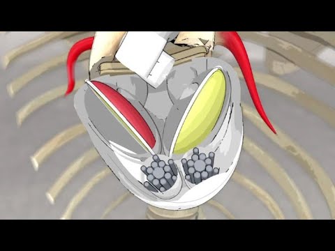 Types of Artificial Hearts Used in Clinical Practice