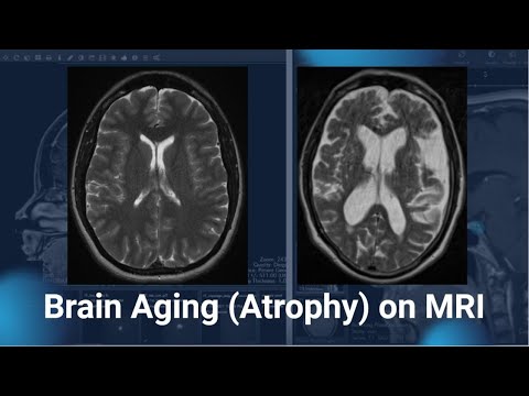 Brain Atrophy on MRI