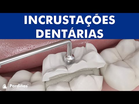Incrustações dentárias ©
