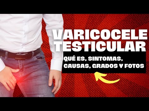 Varicocele Tratamiento : Qué es, Sintomas, Causas, Grados, Fotos y Mucho Más