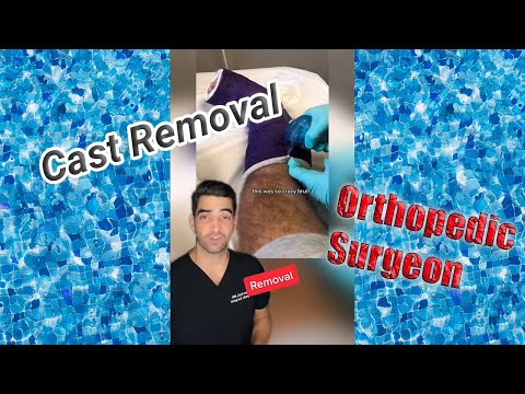 How to remove a fiber glass cast after your broken ankle has healed, learn this proper technique