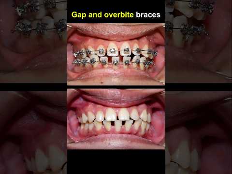 Fix gap and overbite teeth with braces #orthodontist #dentist #dentisty #braces