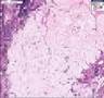 Histopathology Ovary-corpus albicans--Normal-corpus albicans