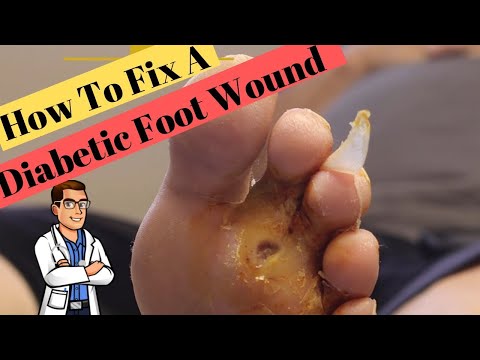 HUGE Foot PIMPLE filled with dead FAT Crystals