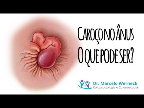 Lump in the anus, could it be cancer?