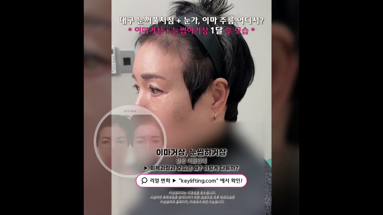 대구 5060의 이마거상 + 눈썹하거상