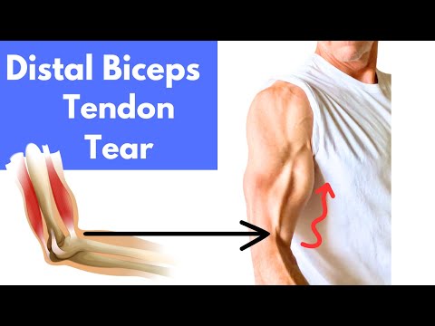 Is Surgery the only Option for Distal Biceps Tendon Rupture? See the Answer here Now!