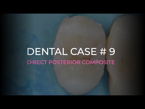 Реставрация боковых зубов I Dental case #9