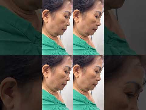 Căng da mặt xong mà da vẫn tự nhiên – bí quyết nằm ở kỹ thuật!