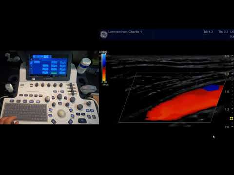 Farbkodierte Duplexsonographie: 11-Schritt-Methode