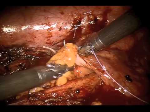 Plastyka moczowodu w asyście robota chirurgicznego