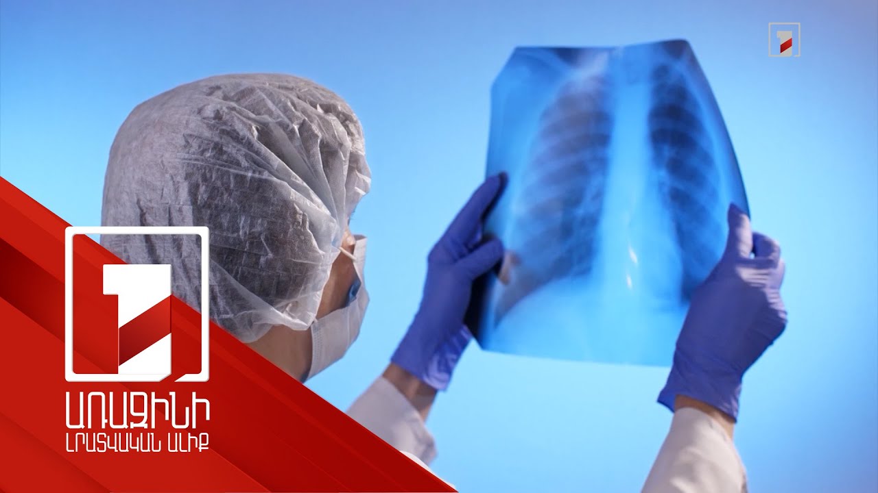 Ֆլյուորոգրաֆիկ հետազոտությունն այլևս էֆեկտիվ չէ. նախապատվությունը տրվել է թվային նոր տեխնոլոգիաներին