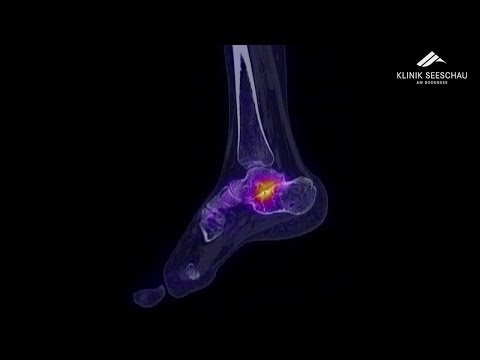 Fuss und Sprunggelenk | Knicksenkfuss / Plattfuss