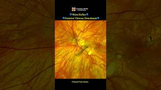 Music video thumbnail preview for Get Rid Of Eye Floaters Fast | Remove The Vitreous | Retinal Detachment Repair | Eye Health Music by Repeated Viewing