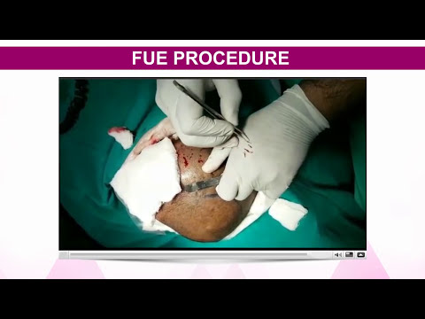 FUE Hair Transplant in Ahmedabad At Avenues Clinic