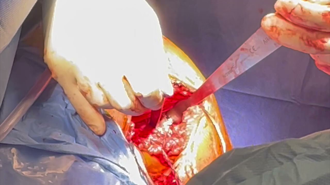 Chronic Pec Tear Reconstruction with Achilles Allograft