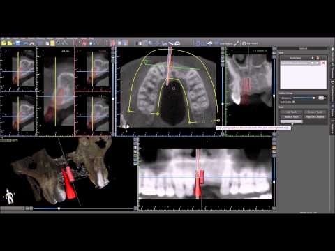 Treatment Planning with Virtual Teeth