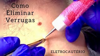 VERRUGAS ACROCÓRDONS (Como Eliminar) @ReginaDinardi