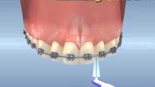 ortodontik tedavi sırasında ara yüz fırçası kullanımı