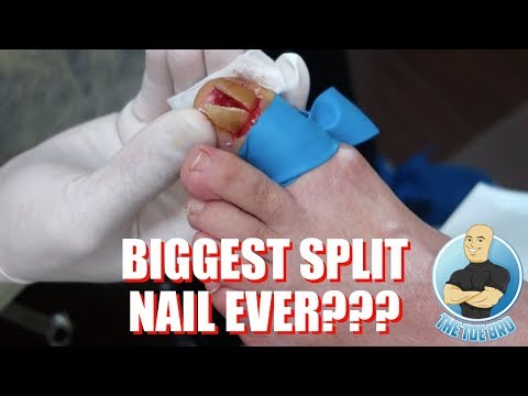 BIGGEST TOE SPLIT EVER? REMOVAL OF EXTREME TOENAIL/LAST NAIL SURGERY IN MY OLD OFFICE :( Video