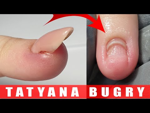 Nail TORN OFF Nail Bed 😱 | Correcting Nails Growing Upward