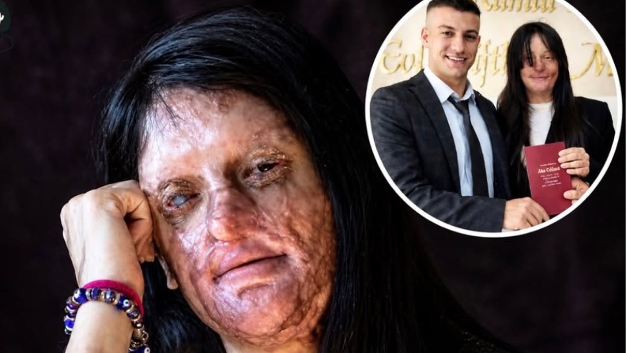 Su ex le DESTROZÓ la cara con ÁCIDO… y años después se CASÓ con él
