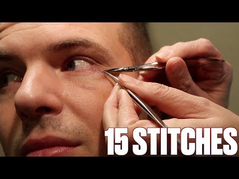 GETTING 15 STITCHES REMOVED AFTER HAVING MY EYE SEWN SHUT IN SURGERY | NO SCAR Video