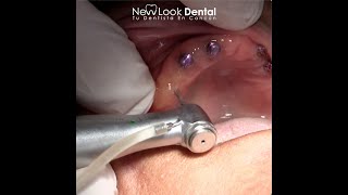 🔵 ASÍ SE COLOCAN LOS MINI IMPLANTES DENTALES 🔵 NEW LOOK DENTAL 🦷 TU IMPLANTÓLOGO EN CANCÚN 🐚