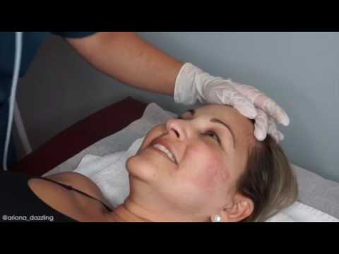 Tummy Tuck Scar Rejuvenation Viva Treatment