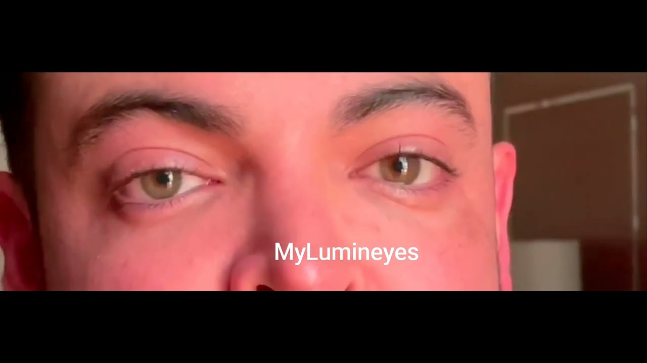 Cirurgia de mudança de cor dos olhos a laser antes e depois #antesedepois #lasereyecolorchange