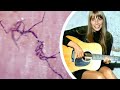 The Rare Disease That Ended Joni Mitchell's Career