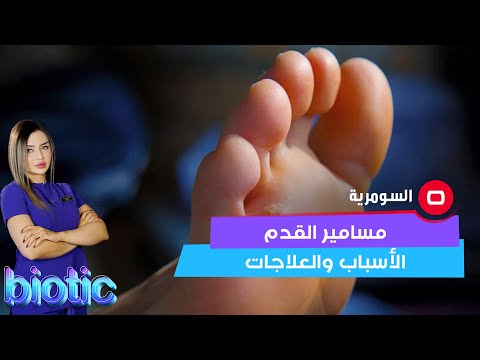 شاهد بالفيديو.. مسامير القدم الأسباب والعلاجات