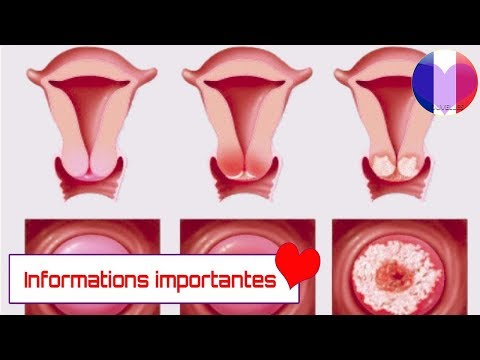 , title : 'Voici les symptômes du cancer du col de l’utérus, chaque femme doit savoir cela !'
