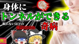 【2004年】皮膚にトンネルができる奇病?我慢できない"地獄のかゆみ"検査でも中々わからない意外な原因『疥癬 ヒゼンダニ感染症』 【ゆっくり解説】