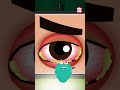 What Is Pink Eye What Causes Conjunctivitis Shorts Pinkeye Conjunctivitis Drbinocsshow