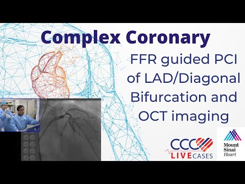 FFR guided PCI of LAD/Diagonal Bifurcation and OCT imaging - CCC Live April 2016