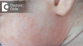 What are the causes of Rashes? - Dr. Rashmi Ravindra