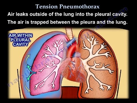 Tension Pneumothorax - Everything You Need To Know - Dr. Nabil Ebraheim