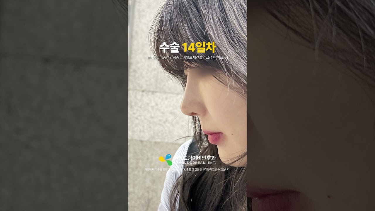 여자 3D 코성형 한달 후기👍 #shorts #비염수술 #비중격만곡증수술 #코성형 #비밸브재건술 #여자코성형 #코성형브이로그 #코성형후기 #코성형전후 #3D코성형