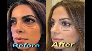 How To Get Rid of Red Puffy Eyes | Top 5 Home Remedies To Remove Bags Under Your Eyes Permanently