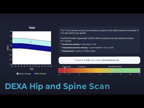 Bodyscan Osteoporosis Dexa Scan