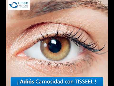 ¿Quieres saber cómo se ve con Pterigion o Carnosidad? El en el siguiente video encuentra detalles de esta enfermedad
