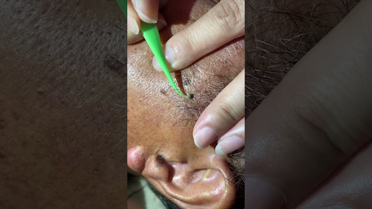 親方様の左揉み上げの角栓を救出へ